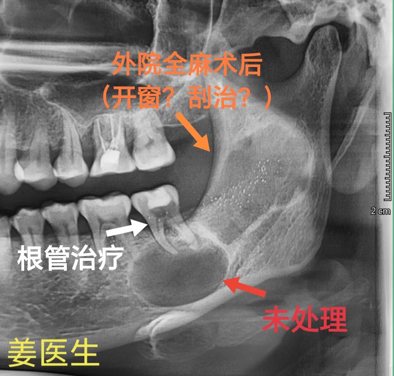 角化囊肿易复发，有的病例需要多次开窗或刮治。这位病人复发位置增加了手术难度。