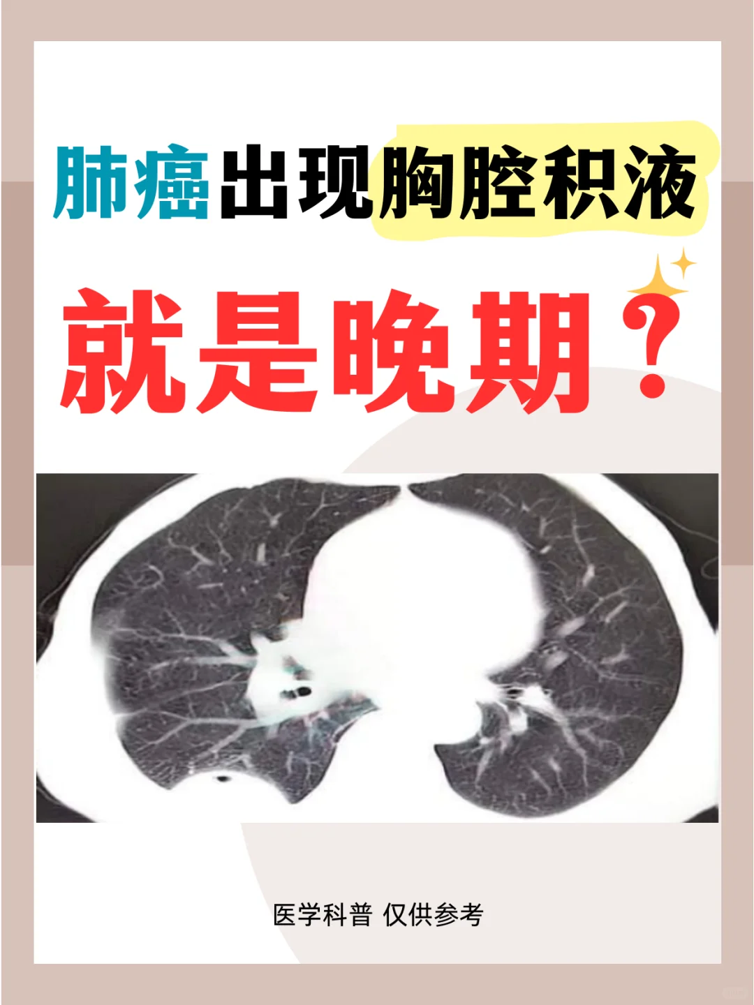 肺癌出现胸腔积液就是晚期了吗？