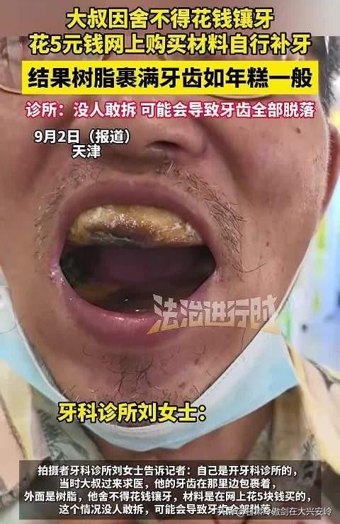 最近自己网上买材料自己补牙，而且还弄坏了牙齿，这种事情越来越多了，是为什么？
