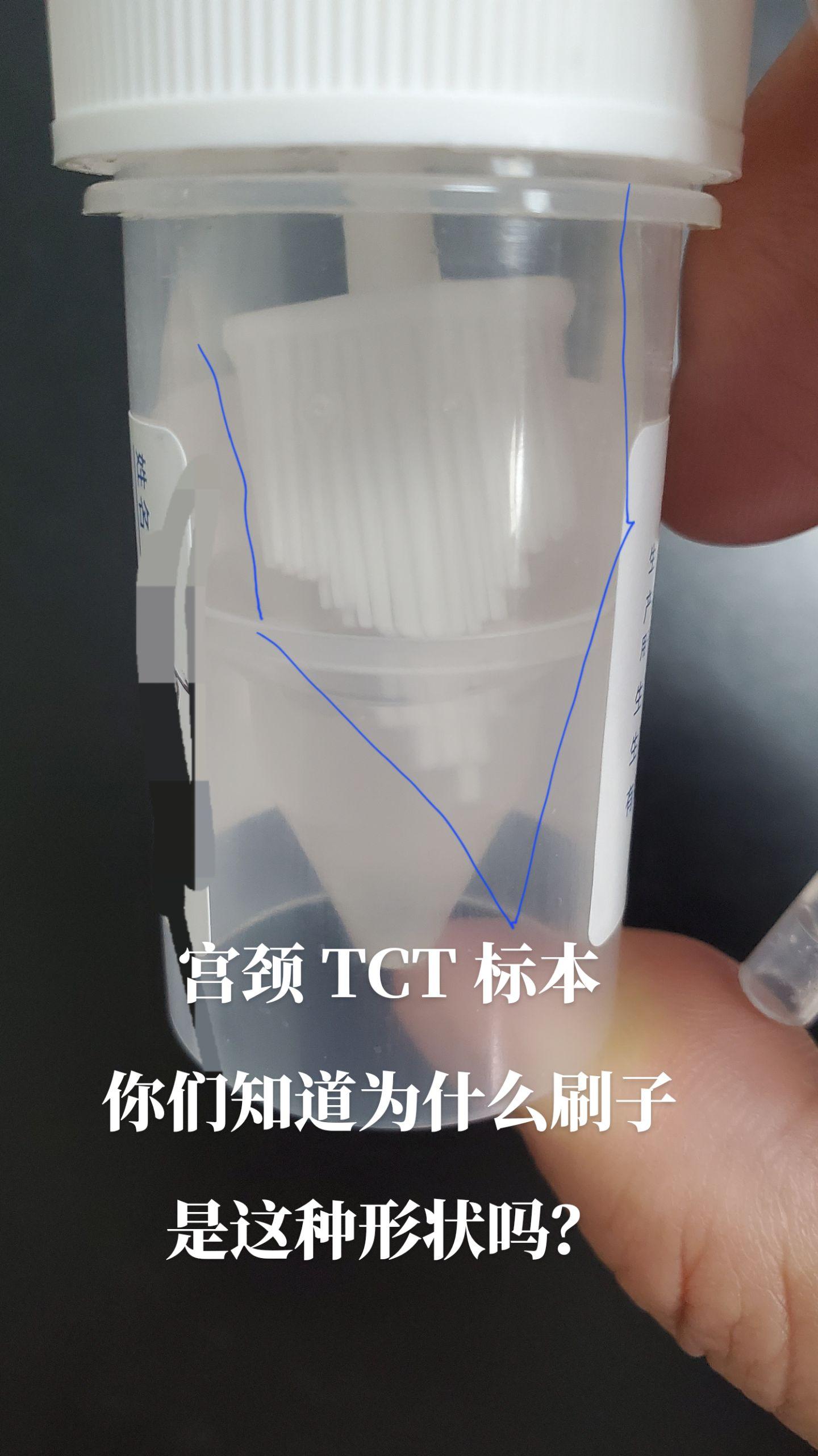 宫颈TCT