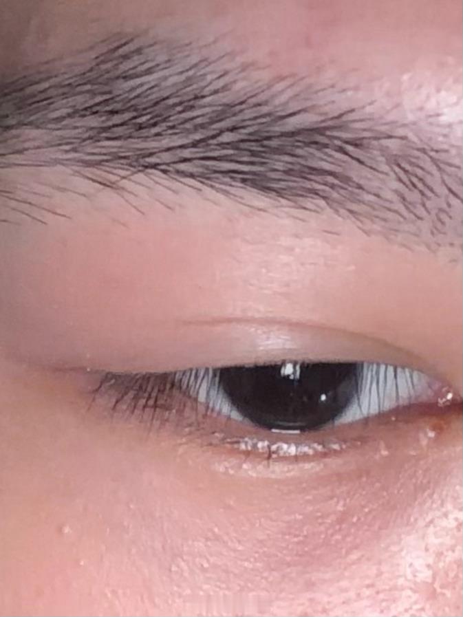 一觉醒来喜提麦粒肿 