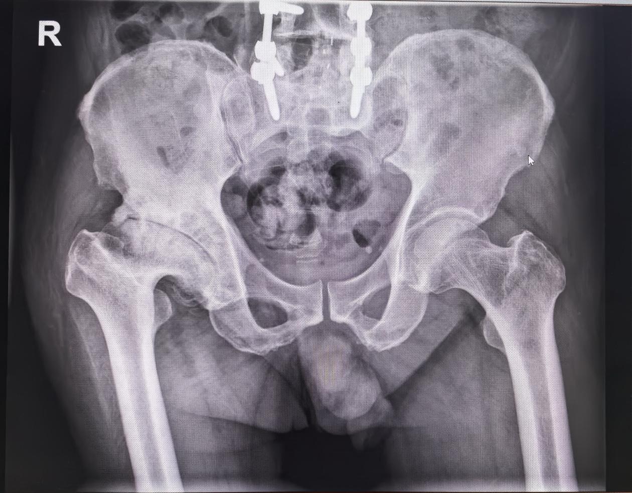 髋关节置换。1、尽量不要拖到这种程度再做手术，增加花费、创伤和手术难度...