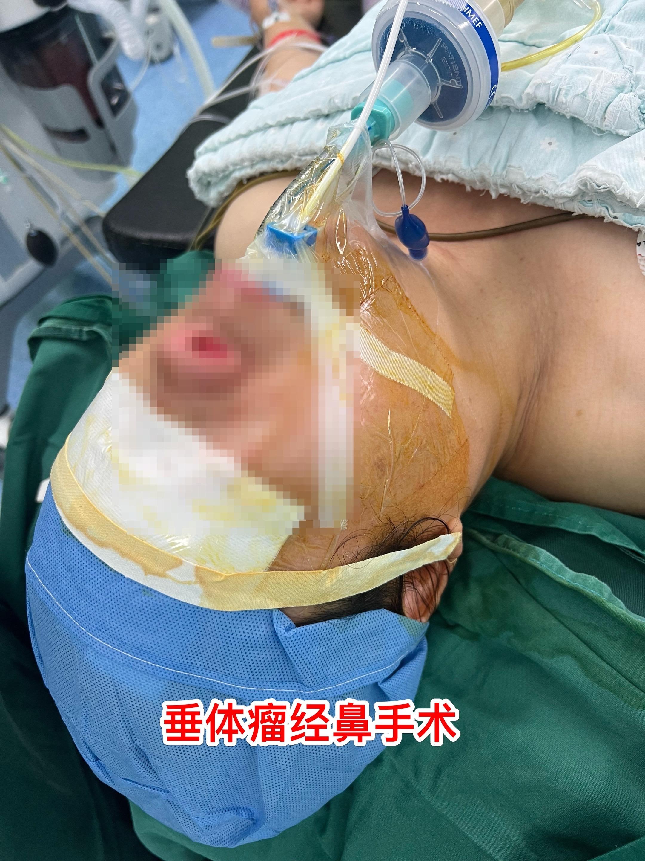 垂体瘤卒中，女教师6月12日突发视力下降。48岁定州市女教师6月12日...