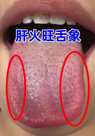 失眠的三大原因：血虚、阴虚、肝火旺，对照舌象，教你正确区分自己属于哪一种
 
一