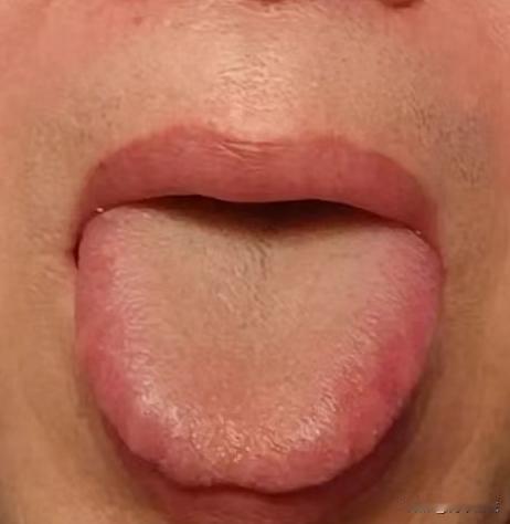 舌头都红成这样了，还不注意，当心津液全给“烤”没了

今天上午看诊了这样一位患者