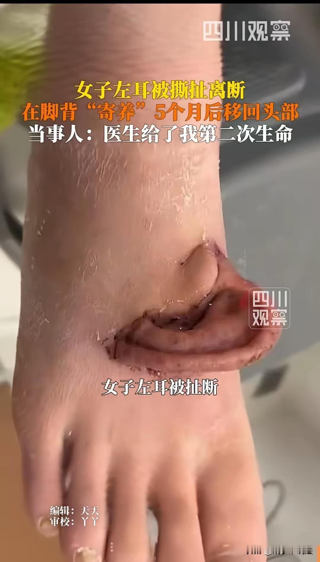 山东，女子发生意外时，左耳与头部完全脱离，医生将她的左耳寄养在脚背上，五个月后又