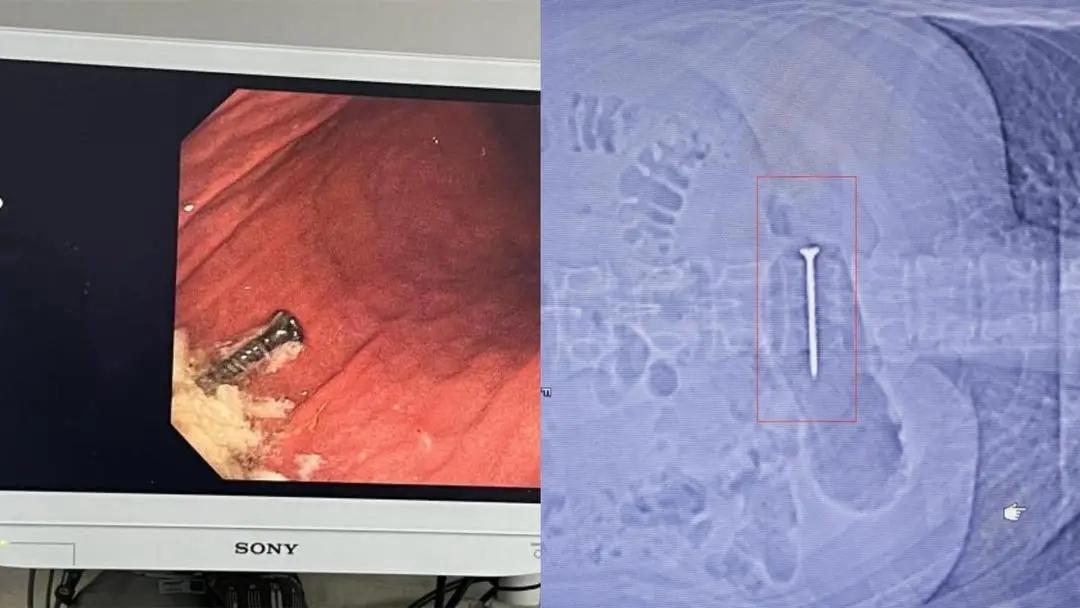 12月21日深夜，广元市第三人民医院急诊医学科上演生死时速——一名因情绪激动吞食