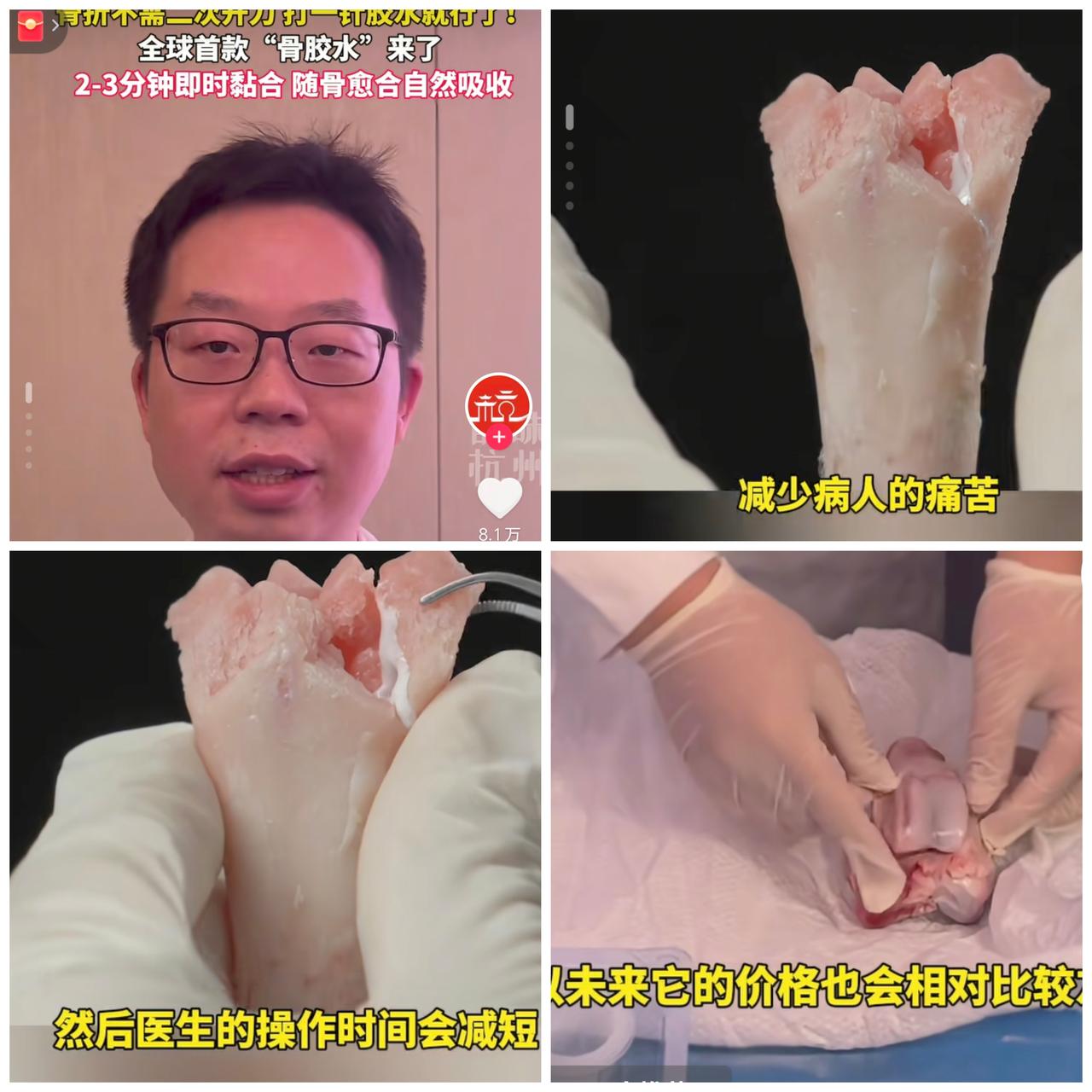 中国医疗又出王炸了！！！
直接震撼全世界！
 浙江邵逸夫医院研发出的全球首款“骨