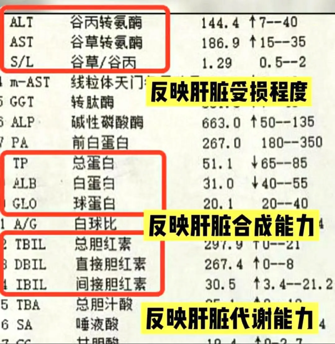 肝功能隐藏的3个“肝硬化”指标！1、转氨酶，超过80肝脏炎症损伤严重...