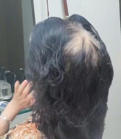 头顶头发稀疏露头皮了咋办？问了老姐妹们，有人说戴假发，有人说坚决不戴假发，因为假