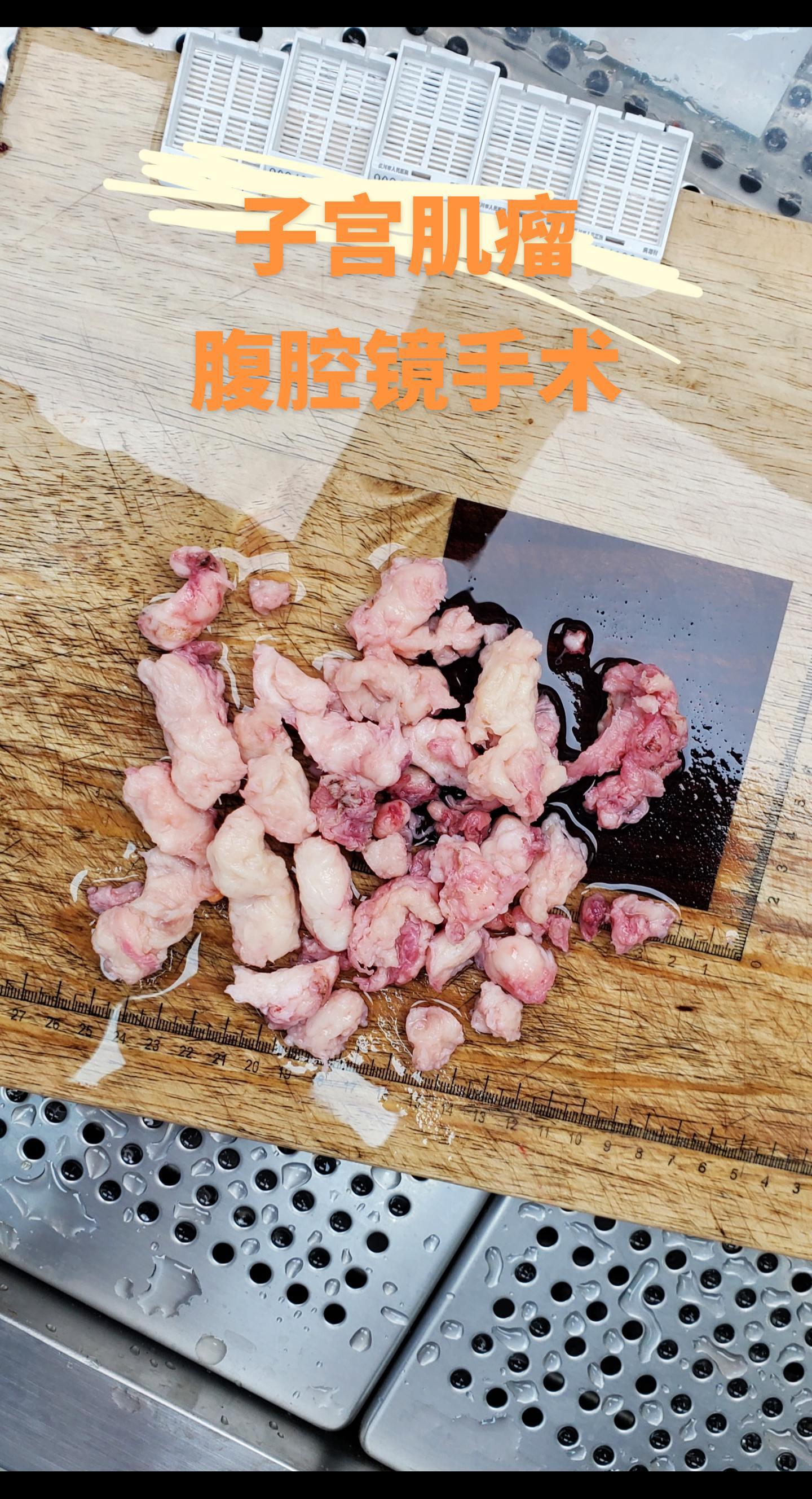 子宫肌瘤