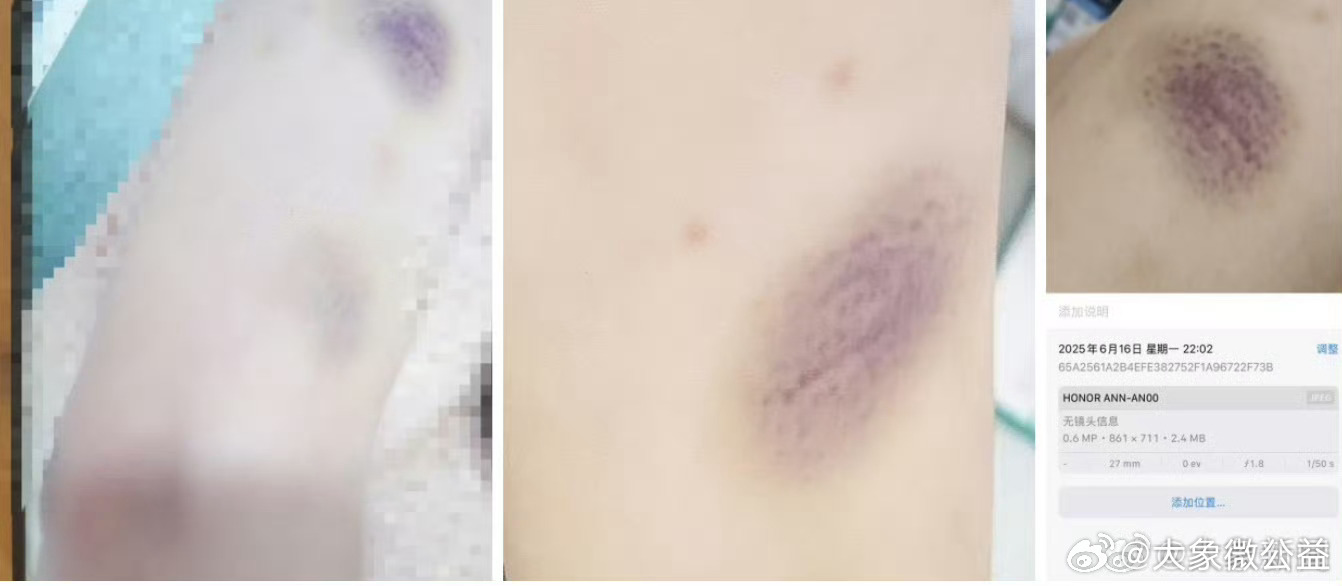 【17岁女生讲述被多次殴打性侵细节：对方疑有暴力倾向】警方回应男大学生殴打女生案