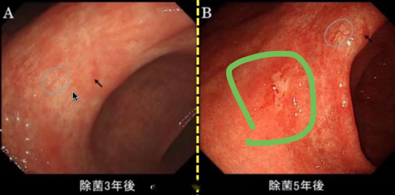 胃癌的预防是分级的，一级预防就是不要让儿童在幼年时期感染幽门螺杆菌，但是已经感染