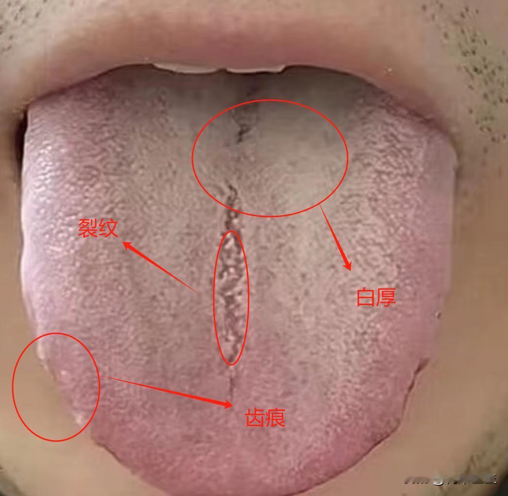 这个原因的齿痕舌这样调理，事半功倍

今天看了一个脾胃虚弱的齿痕舌患者，他说自己