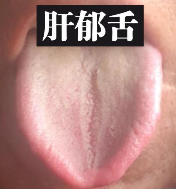 男性注意！肝郁舌，湿热舌，阳虚舌，出现一个当心男科问题找上门！

1、舌两边鼓胀