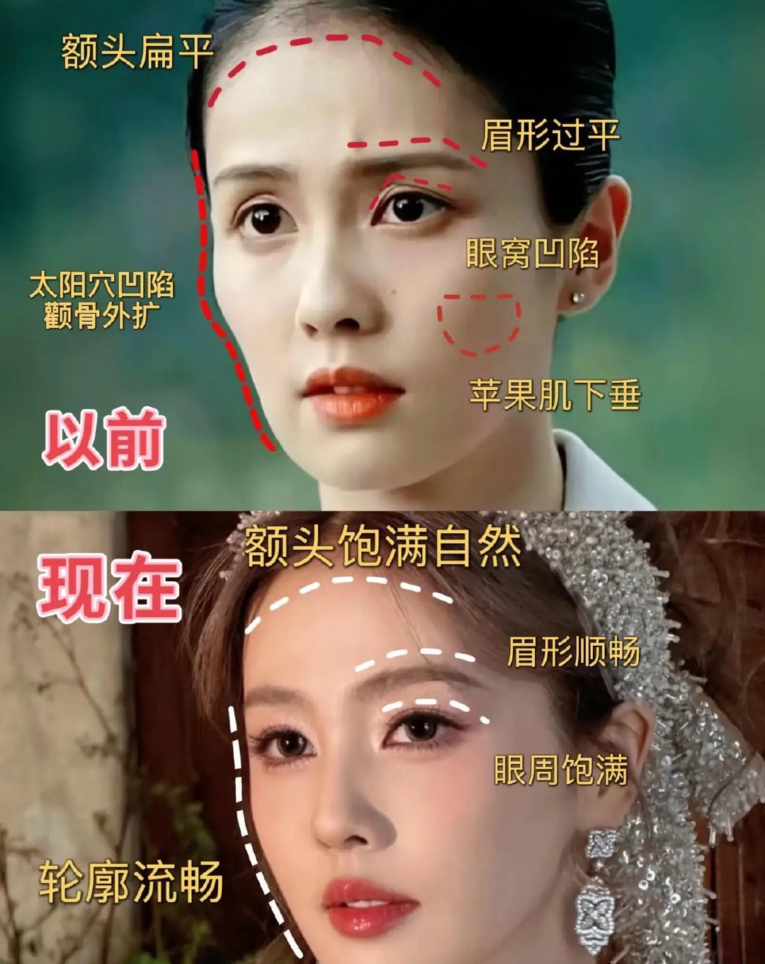 白鹿这几年的面部变化蛮大的，早期脸部轮廓并不美观，眉毛也不毫无规则，给人一种很疲
