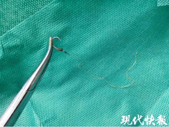 “简直不可思议！”江苏镇江，59岁女子肛门疼痛难忍，自己摸有一线头，拽一下痛的差