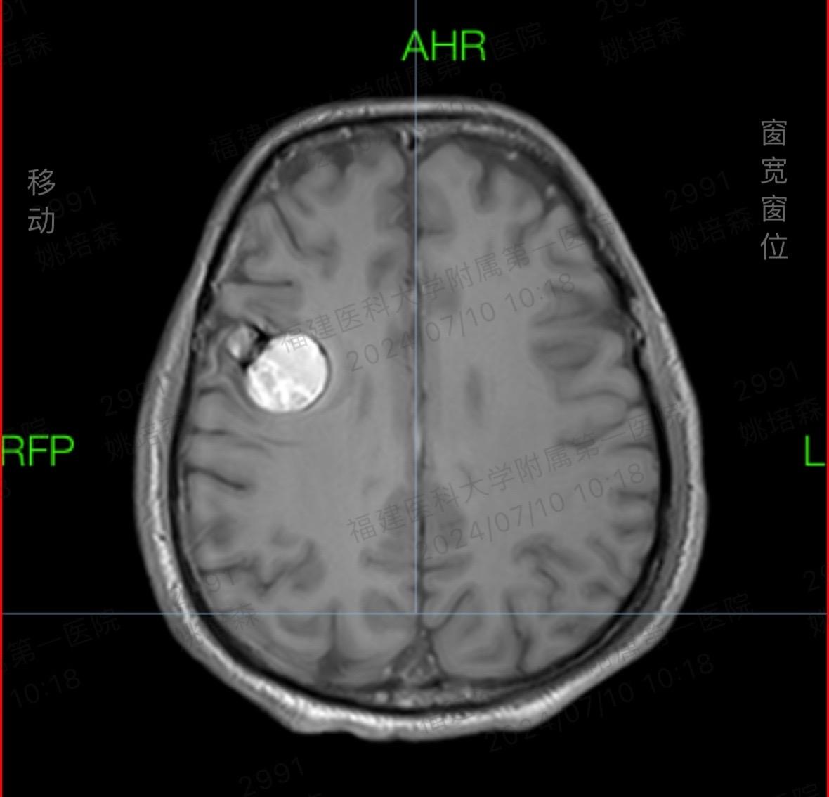 脑内血管瘤合并癫痫。其实海绵状血管瘤如果在非功能区手术难度一般，但是如...