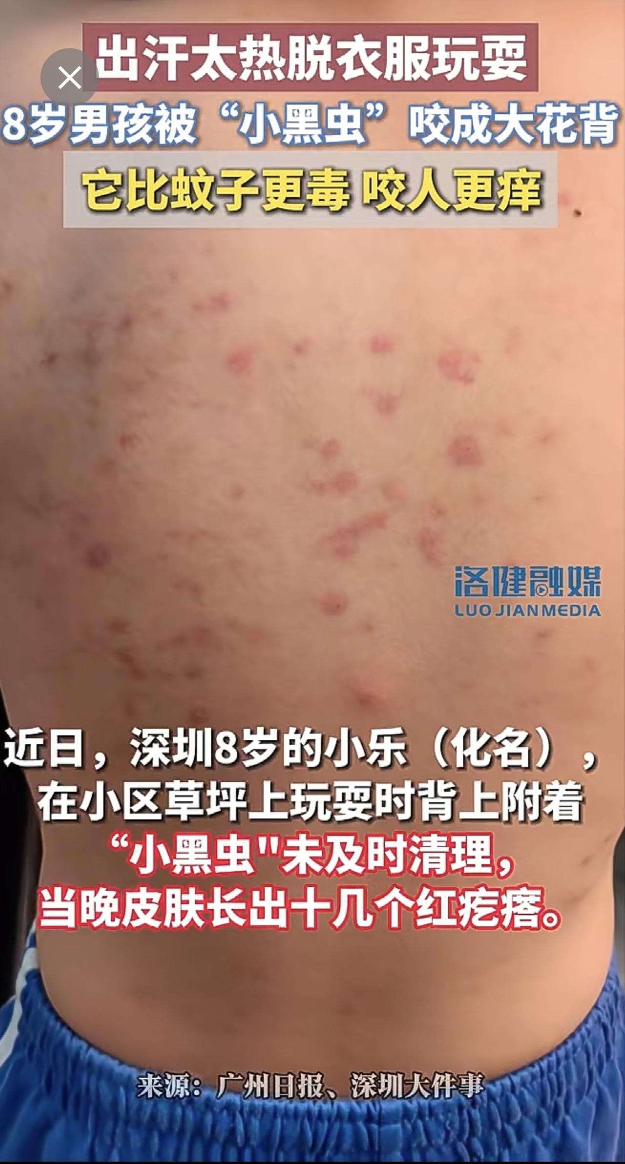出汗太热脱衣服玩耍，8岁男孩被咬成大花背（来源：广州日报、深圳大件事）
