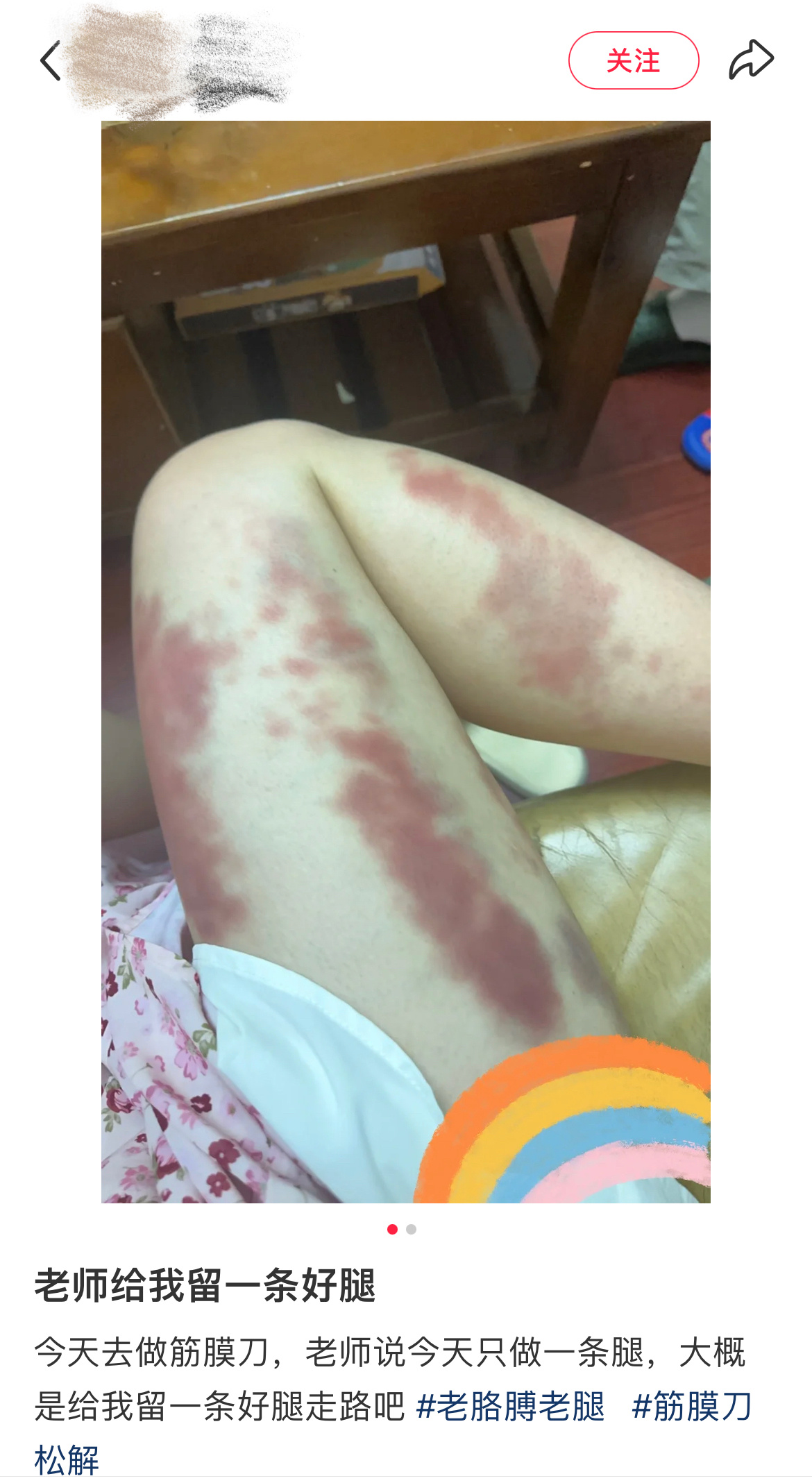 筋膜刀并不是越疼越好 刷到一个做完筋膜刀的帖子实在震惊我……可能很多人觉得疼才有