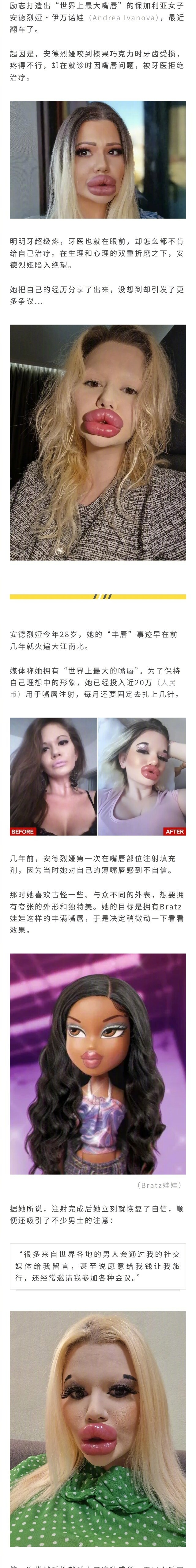 美女砸20万丰唇成“世界最大嘴唇”，最近悲惨翻车：牙疼得要死，但是没有牙医敢掰开