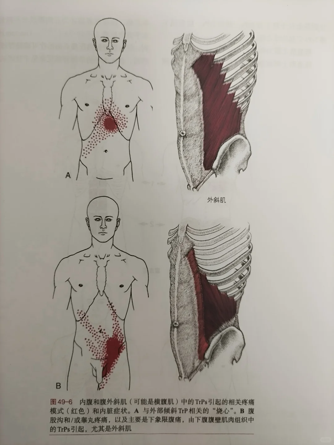 腹斜肌触发点表现