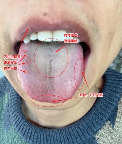 这种舌头，为啥疏肝、健脾、补阳没有用？其根本原因是血瘀！
 
患者平时性格急躁，