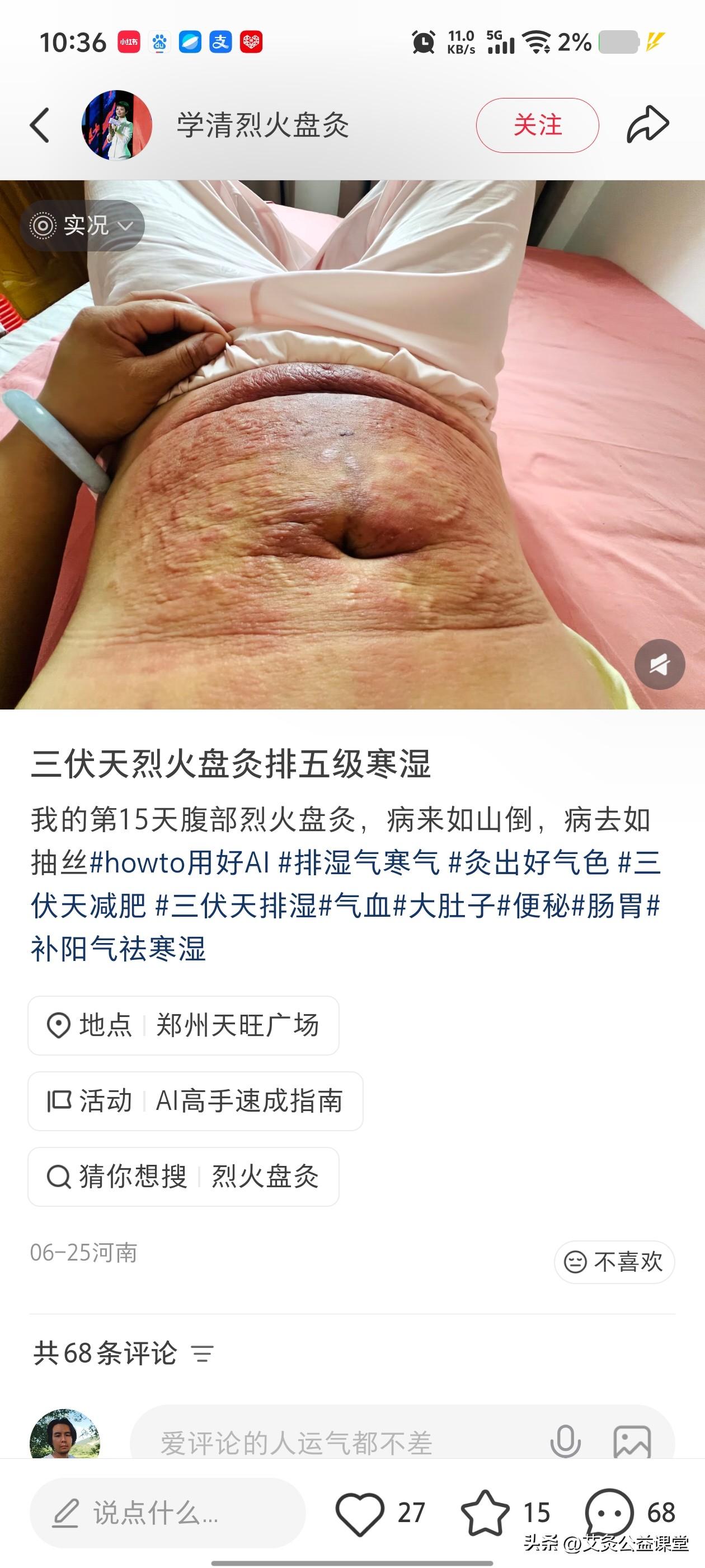 小蓝书上的艾灸博主
乍一看还是以为烤的乳猪呢
仔细一看才知道是艾灸！
大家推崇这