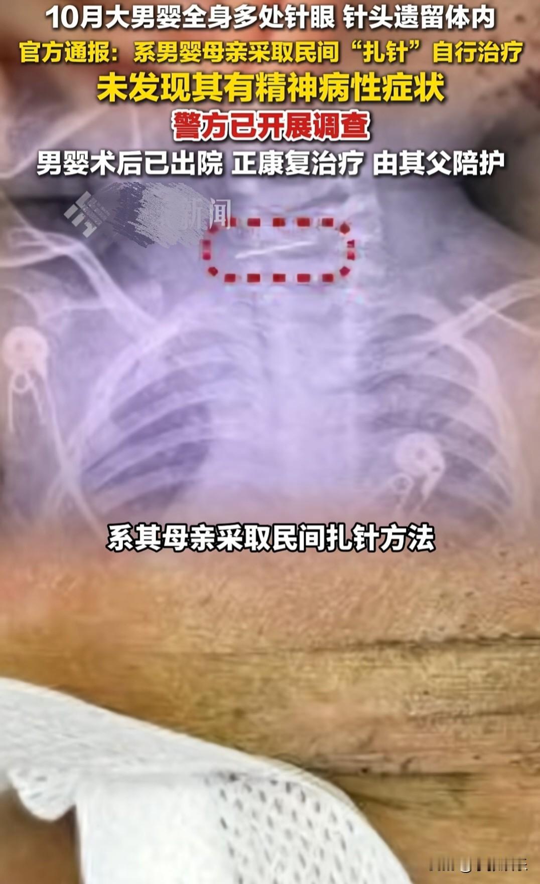 “太心疼了”，云南10个月宝宝被亲妈扎了几百针！颈椎里还留着带倒刺的锈针

云南