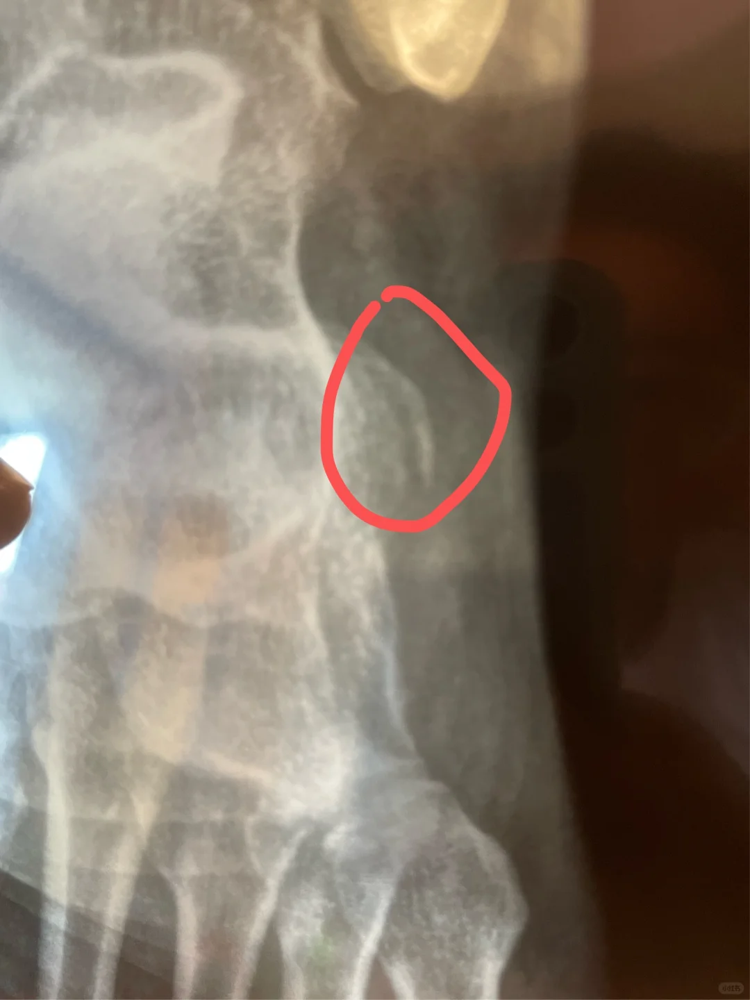 崴脚骨折一个月，骨头在慢慢愈合