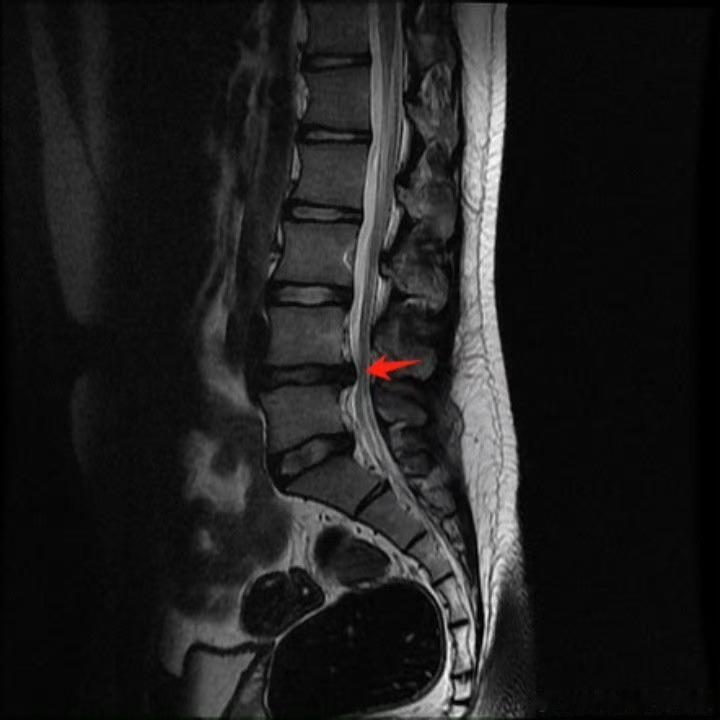腰椎间盘突出 【腰突总担心要手术？】这个话题，我在线下初诊或答疑中常常遇到，今天