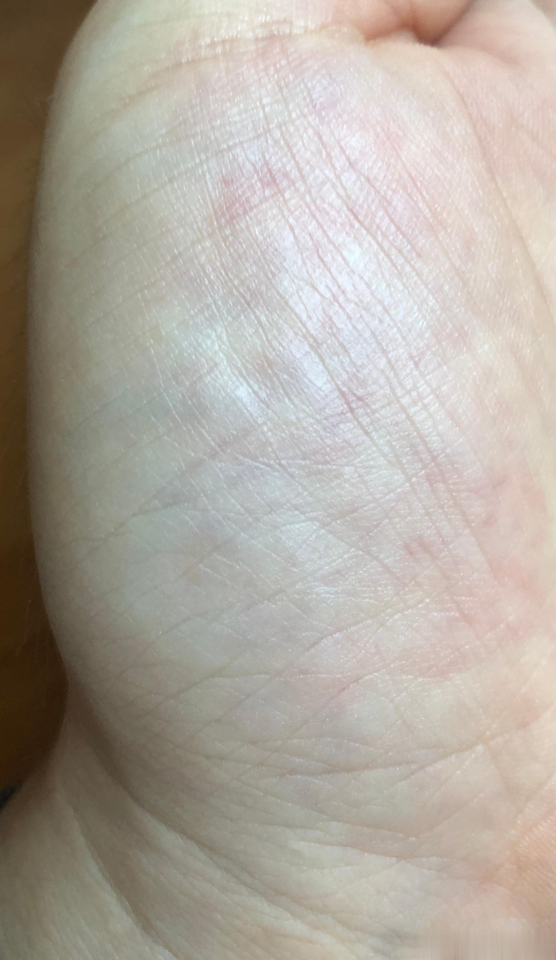 “凡诊络脉，脉色青则寒且痛，赤则有热。其暴黑者，留久痹也；其有赤有黑有青者，寒热