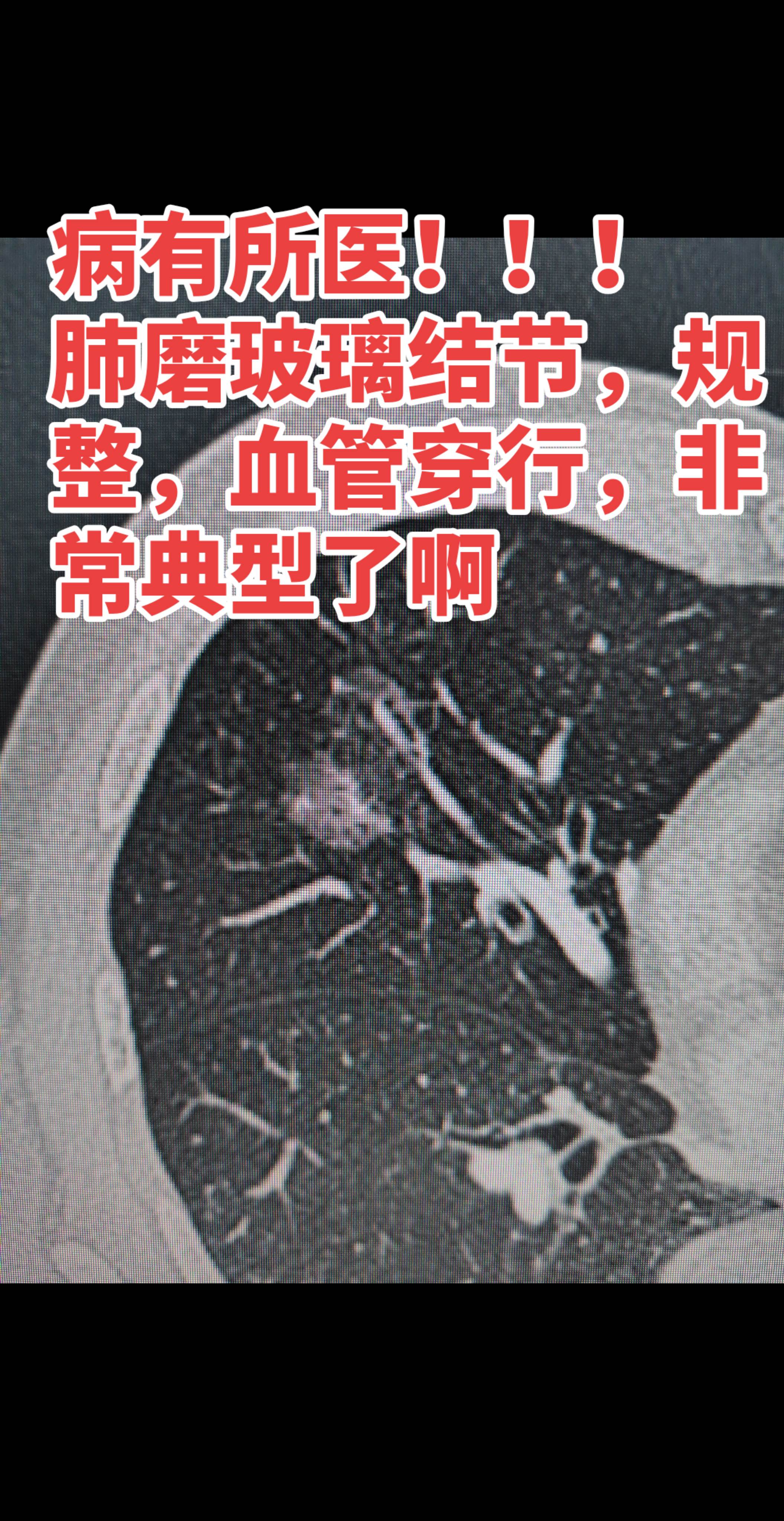 肺磨玻璃结节。肺磨玻璃结节，正规就诊，多有好的结果
