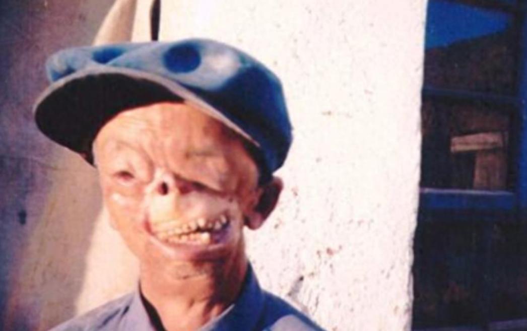 1950年，年仅3岁，就被狼咬掉了半张脸，父亲将其无情的扔到山洞中，没想到他却顽