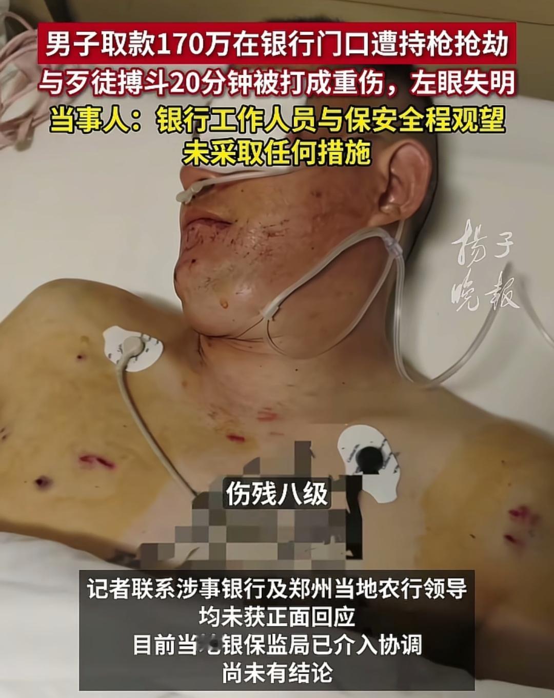 取款170万在银行门口遭持枪抢劫，与歹徒搏斗20分钟被打成重伤左眼失明，银行工作
