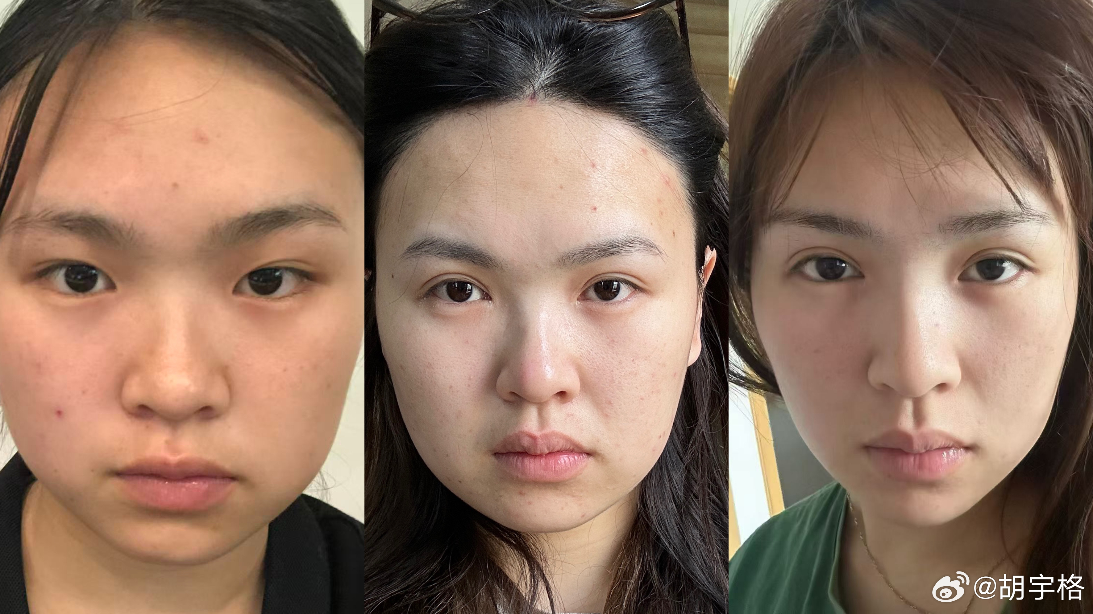 雷霆变化，又有内容输出了割了双眼皮，没整鼻子 