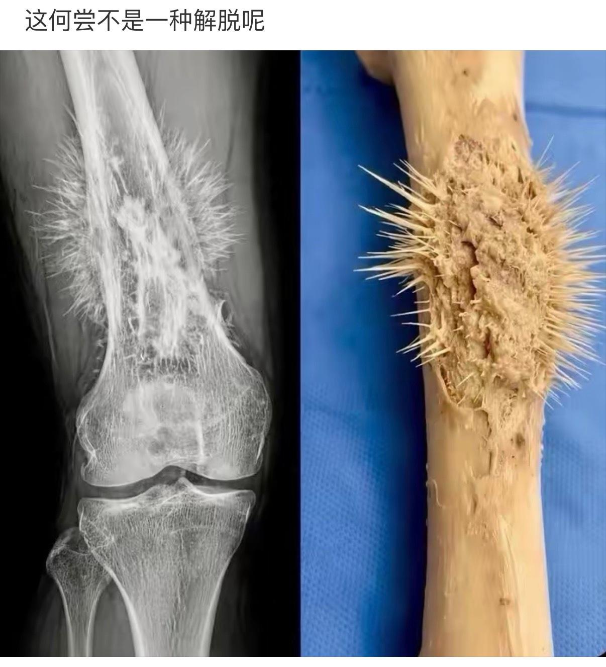骨癌…据说最后都是疼死的，止疼药不管用了… 