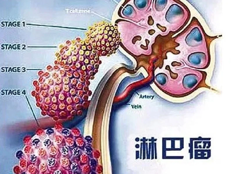 【淋巴结肿大/显示】不一定是淋巴瘤！