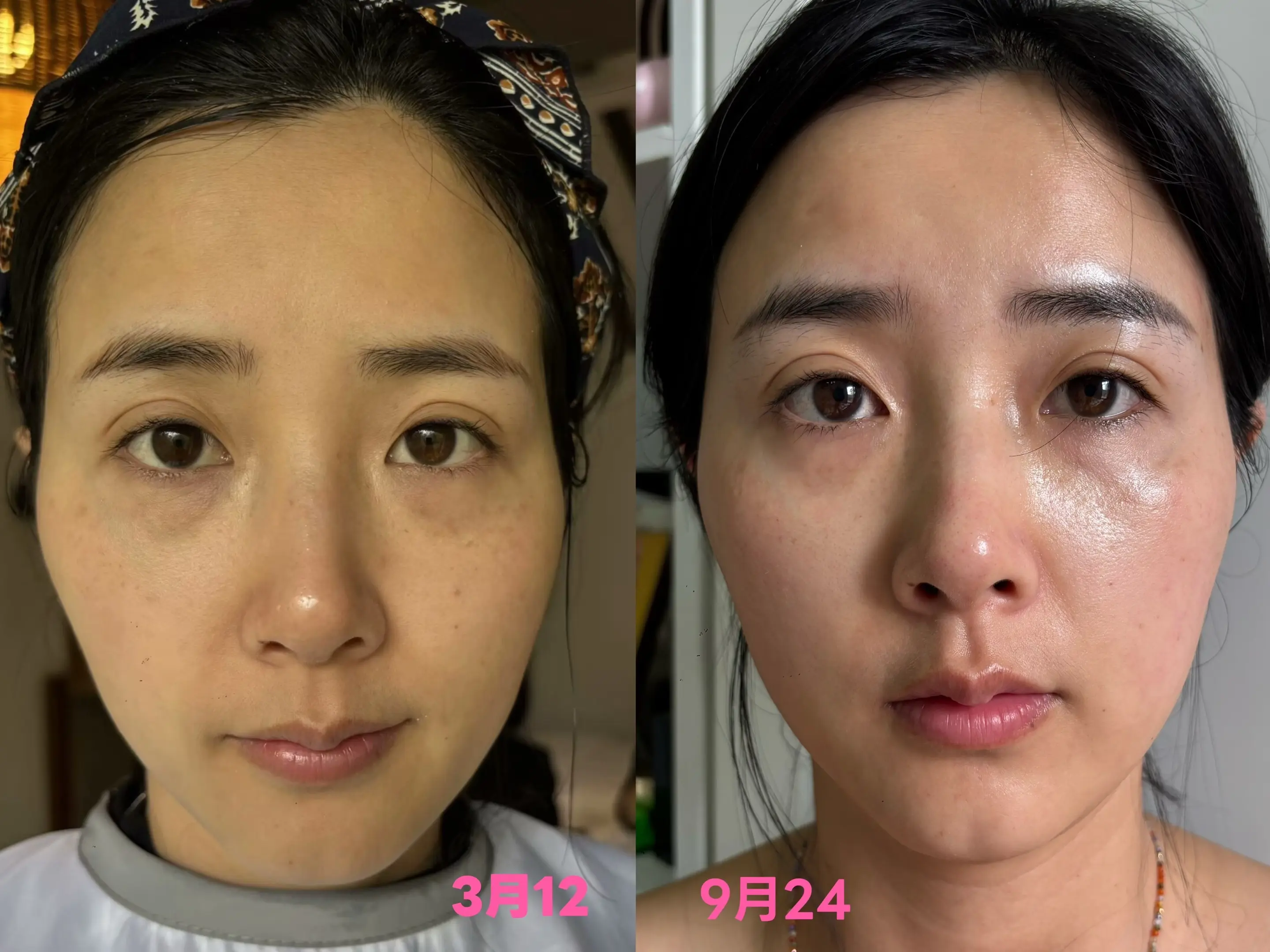 好产品真的会说话2025年3月13号用产品前，因为熬夜矫正牙齿皮肤松弛...