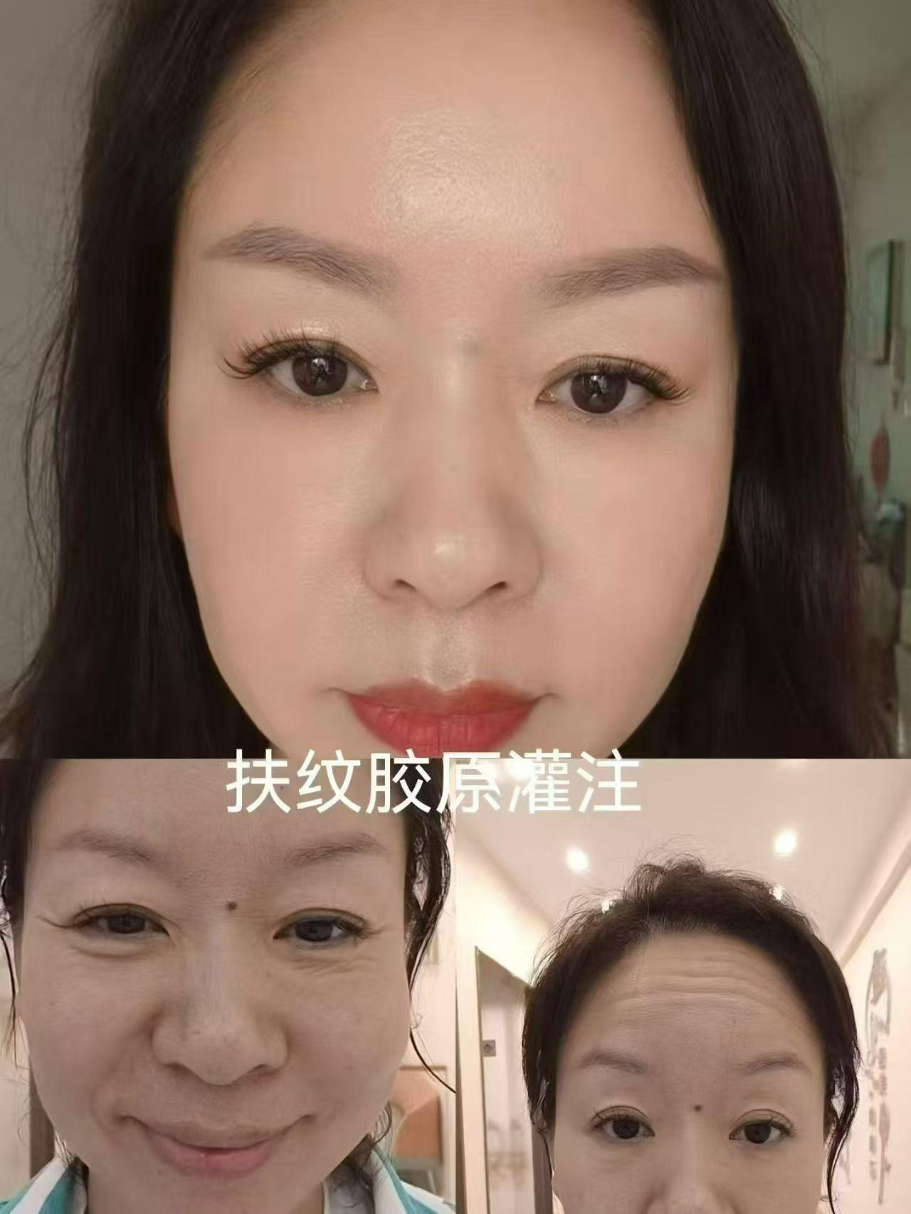 悦太美扶纹胶原灌注，上庭皱纹全部扫光光😎不僵硬不假脸，想自然变美的福音🥰