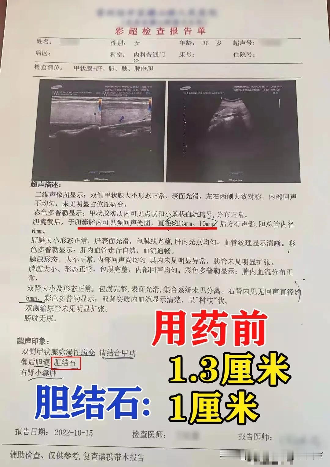 患者2022年11月6号就诊，期间服药一个半月，2023年2月7号复查，结石缩小