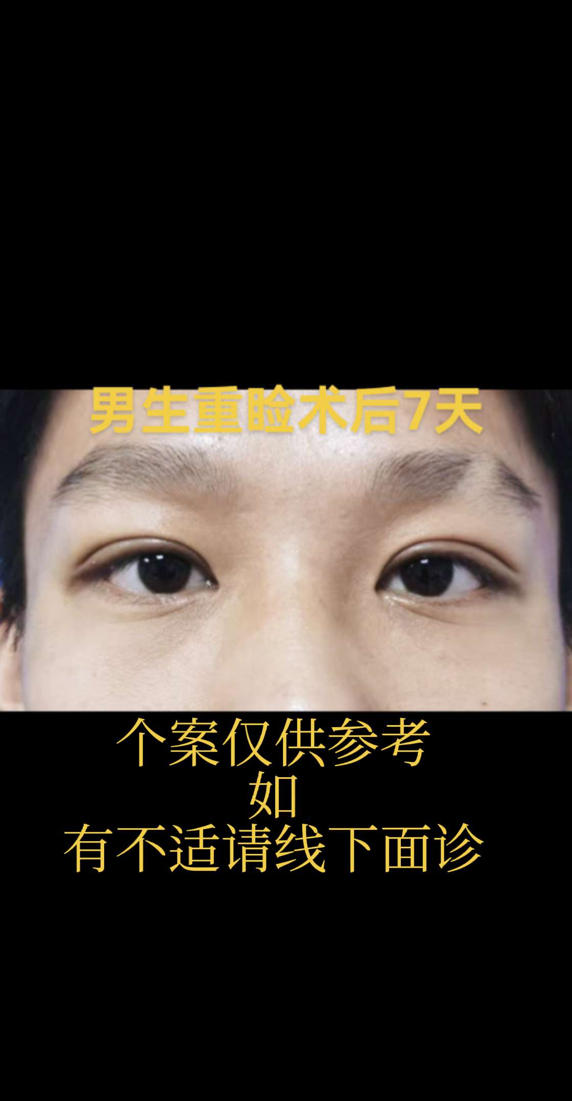 男生双眼皮，不要宽！医学科普