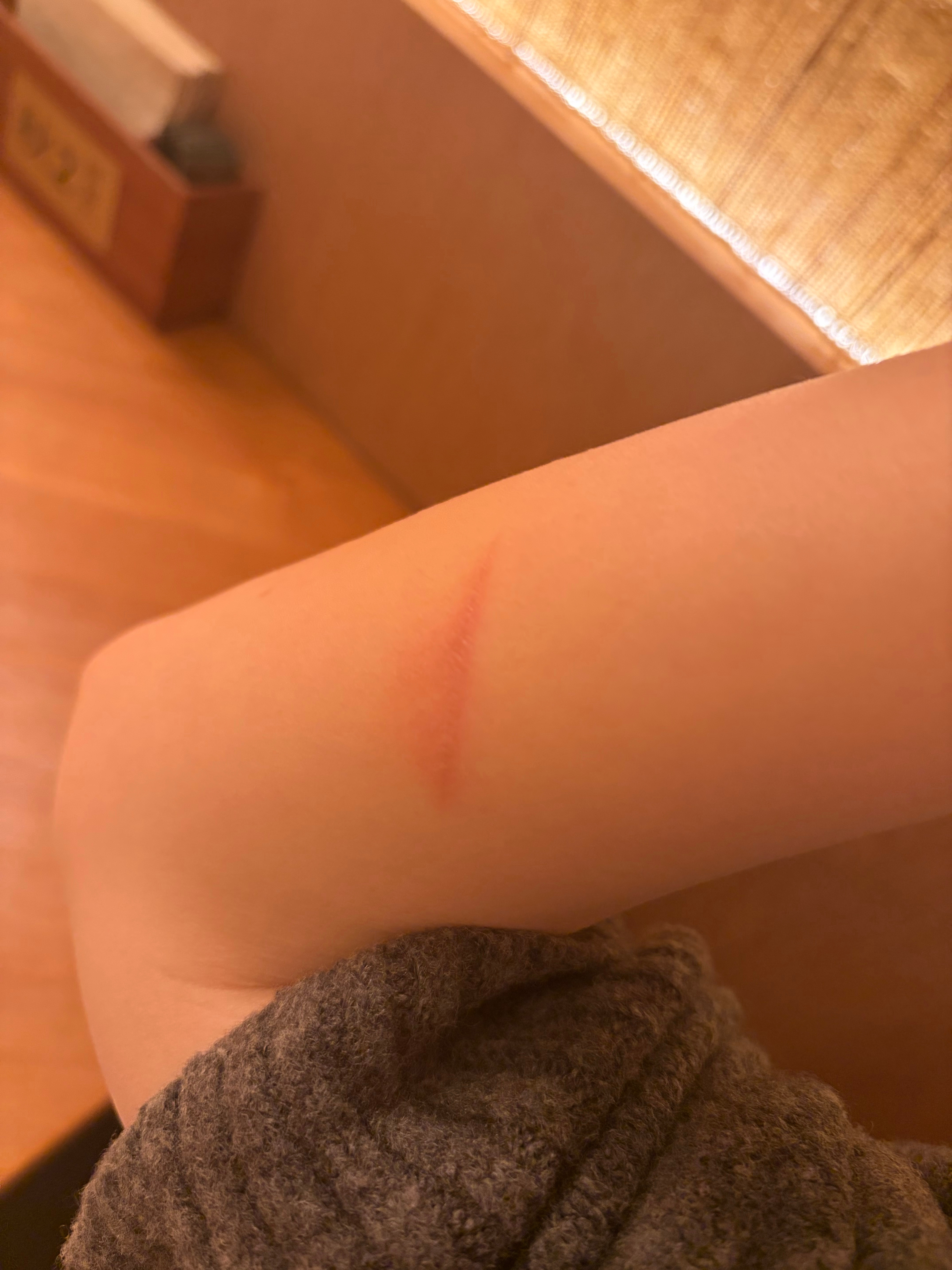 被烫伤了🆘友友们有无好用祛疤膏推荐！！ 