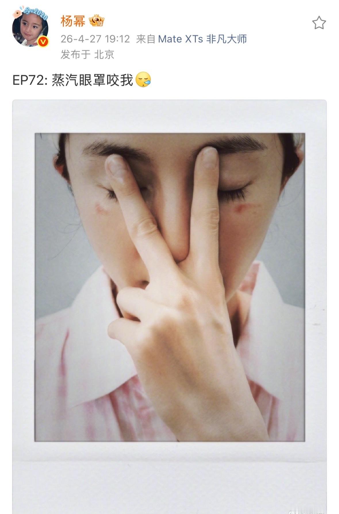 杨幂被蒸汽眼罩烫伤了杨幂眼部被蒸汽眼罩烫伤了我的天杨幂被蒸汽眼罩咬伤了杨幂晒眼部