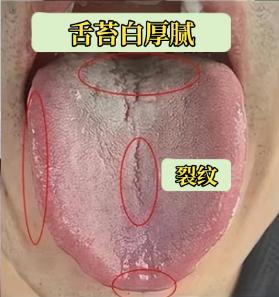 房事不节制、肾已透支！舌苔黄腻≠肾虚，盲目补肾越补越废！先通后补才是真来劲
大家