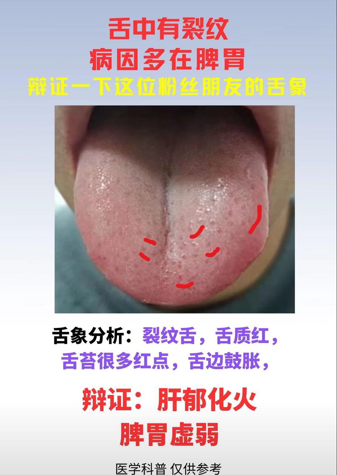 舌中有裂痕 病因多在脾胃