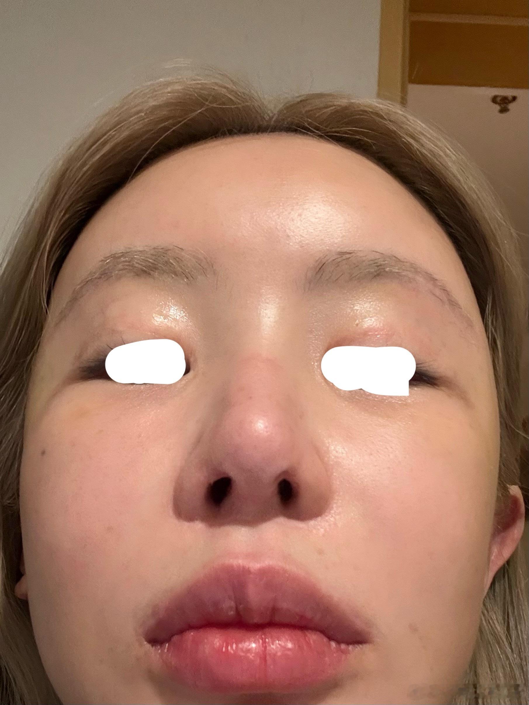 皮肤好成啥了，连续几天熬夜摸起来皮肤还是嫩的。大概率还得是韩国re2o+肉毒+丽