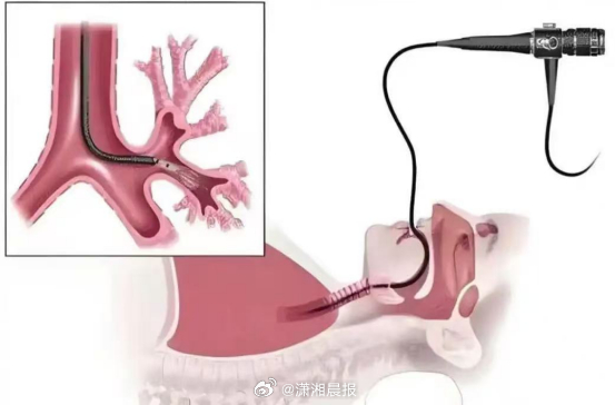 【支气管还能洗？#65岁大爷突发脑梗死气管被切开#】#医生回应给脑卒中患者做肺部