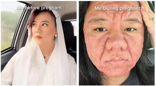 这是一个人？
她孕前还像娃娃脸大学生，
孕后直接毁容，全脸长痘！

马来西亚妹子