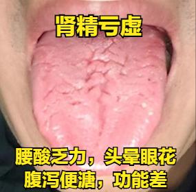 需分析，舌象留下就行！

#舌诊##健康科普#
